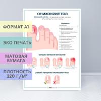 Онихокриптоз (уценка)