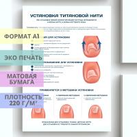 установка титановой нити (плакат)