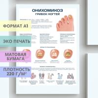 онихомикоз. грибок ногтей (плакат)
