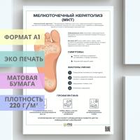 мелкоточечный кератолиз