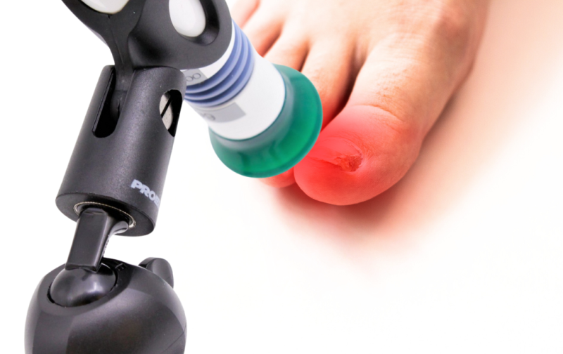 Все об аппарате АФС-Подолог (АФСк-660) для противогрибковой обработки ногтей