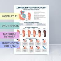 Диабетическая стопа (плакат)