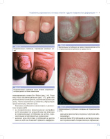 Дифференциальная диагностика поражений ногтей. Атлас_11