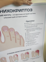 Онихокриптоз (уценка)