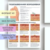 подошвенная бородавка (плакат)