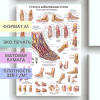 стопа и заболевания стопы (плакат)